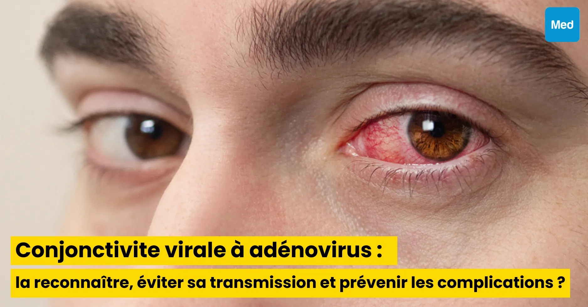 Conjonctivite virale à adénovirus : comment la reconnaître, éviter sa transmission et prévenir les complications ?